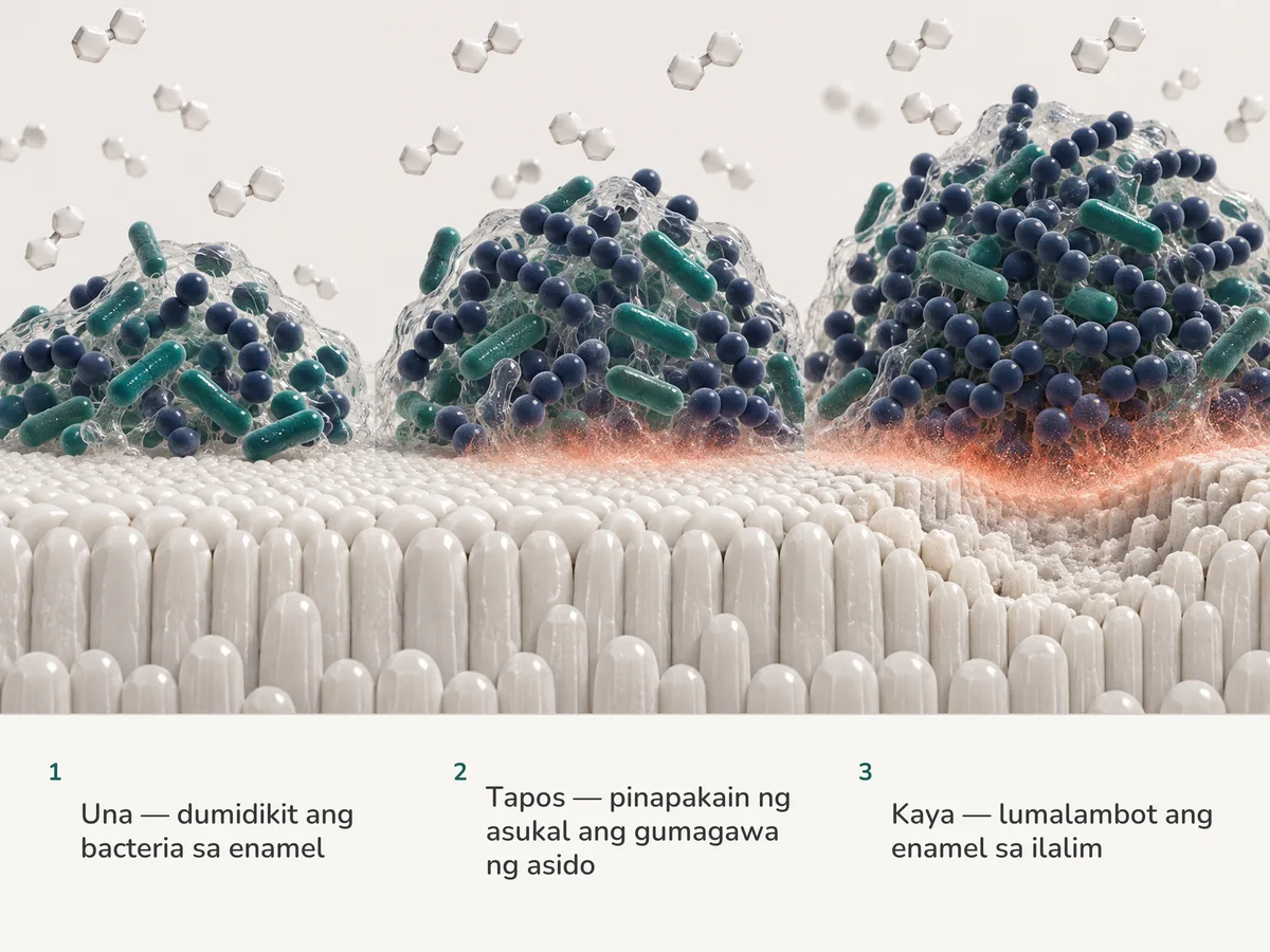 Ilustrasyon: tuloy-tuloy na dumarating ang asukal sa bunton ng plaque sa enamel ng ngipin, nangingibabaw ang bilog na bacteria na gumagawa ng asido, at pinalalambot ng korales na ulap ng asido ang enamel sa ilalim