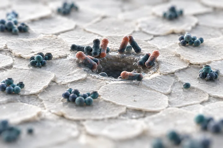 Illustration: traubenförmige Haufen runder Bakterien auf den flachen Zellen der Hautoberfläche und korallenrote kurze Stäbchen am Rand einer Pore